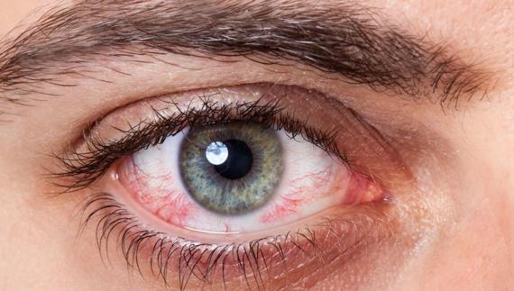 _glaucoma2