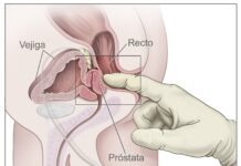 Día Mundial del Cáncer de Próstata