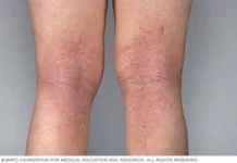Día Mundial de la Dermatitis Atópica